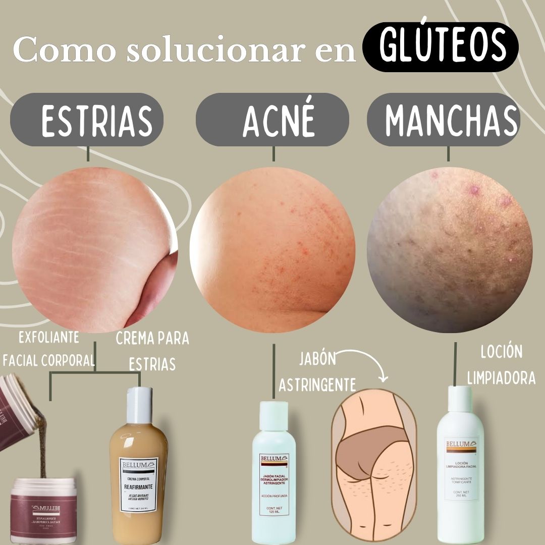 Cómo solucionar estrías acné y manchas en glúteos 🍑